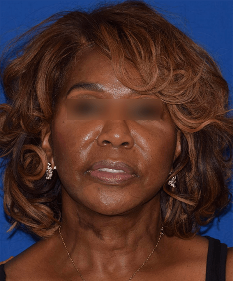 Cosmetic Surgical Before & After Gallery - Patient 63360898 - Image 2