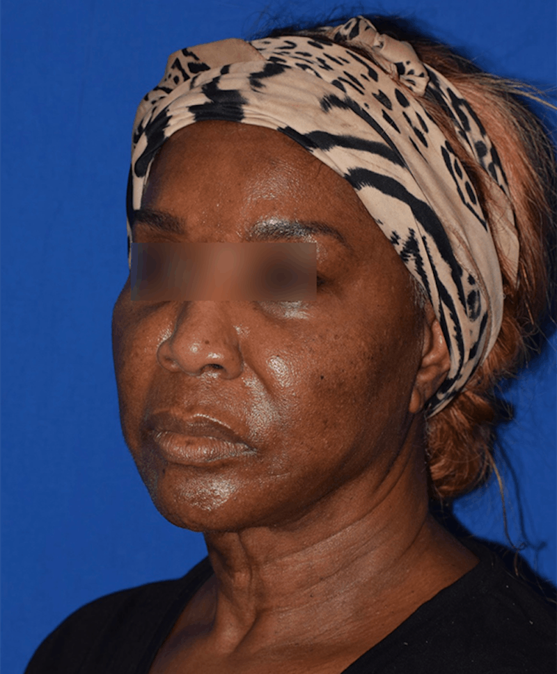Face Before & After Gallery - Patient 63360898 - Image 3