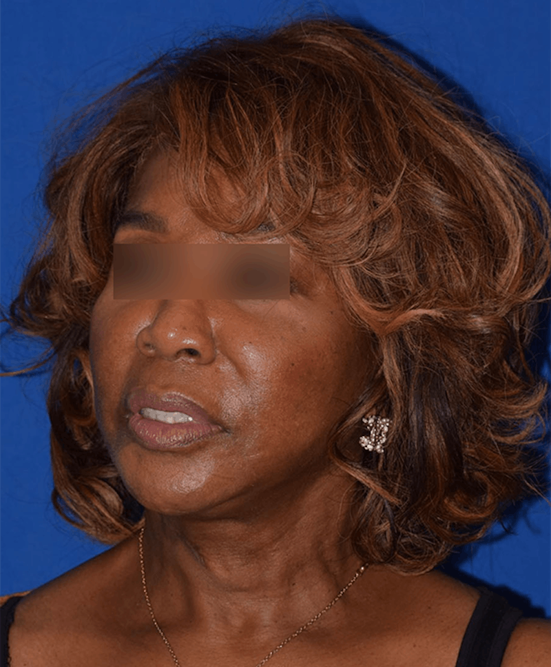 Face Before & After Gallery - Patient 63360898 - Image 4
