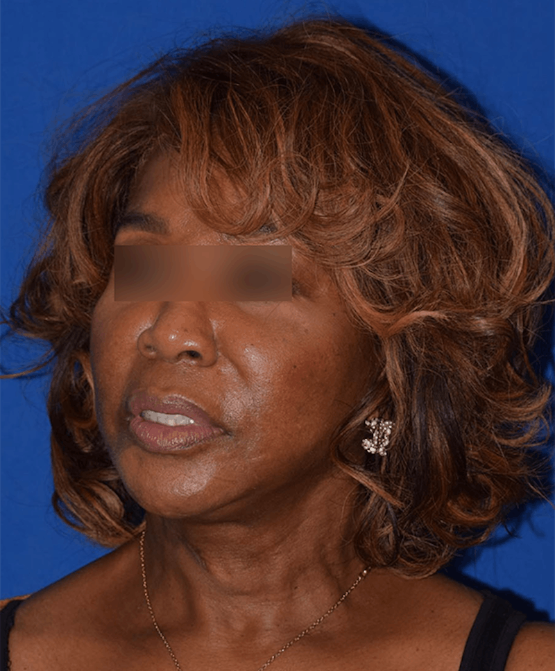 Cosmetic Surgical Before & After Gallery - Patient 63360898 - Image 4