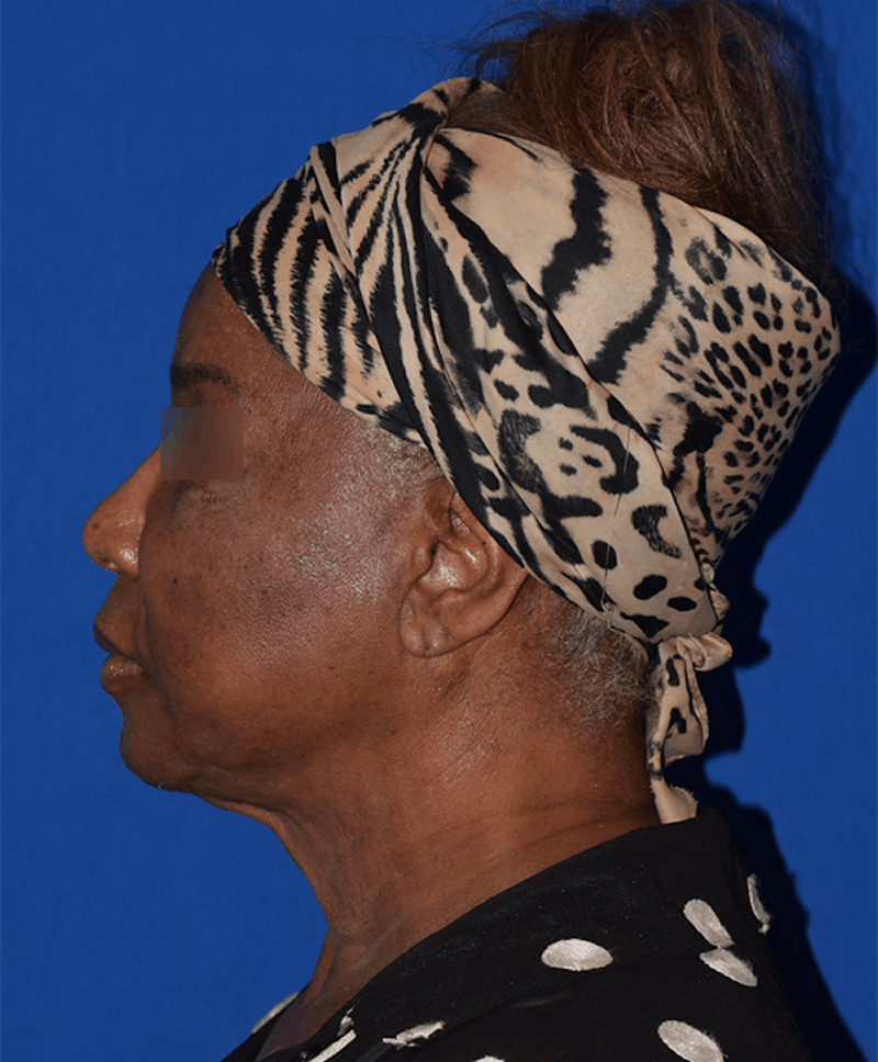 Face Before & After Gallery - Patient 63360898 - Image 5