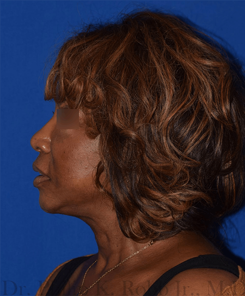Face Before & After Gallery - Patient 63360898 - Image 6
