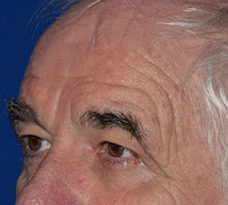 Face Before & After Gallery - Patient 63360905 - Image 3