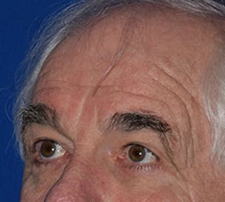 Face Before & After Gallery - Patient 63360905 - Image 4