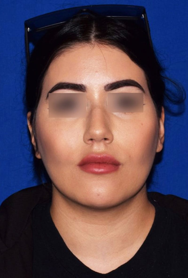 Face Before & After Gallery - Patient 63360909 - Image 2