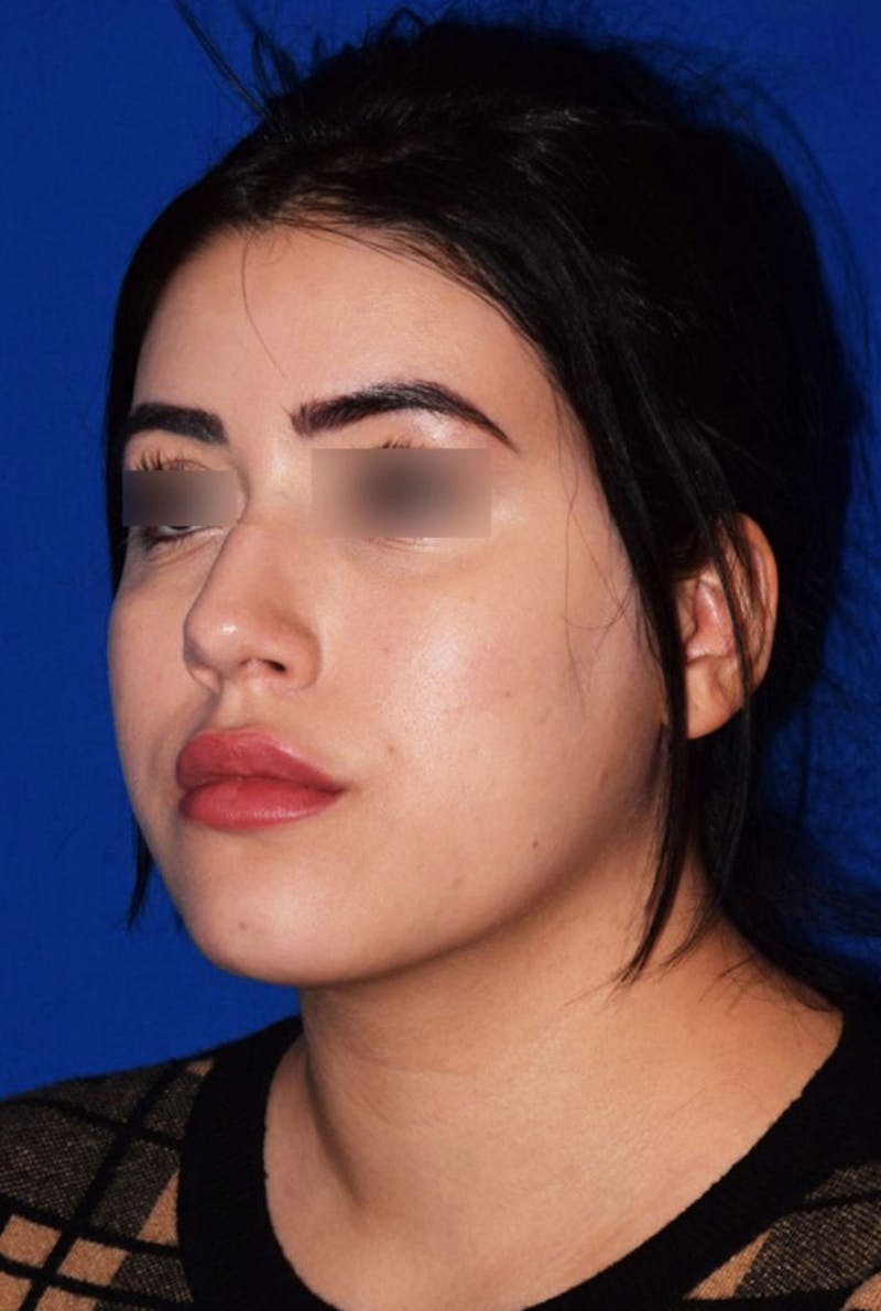 Face Before & After Gallery - Patient 63360909 - Image 3