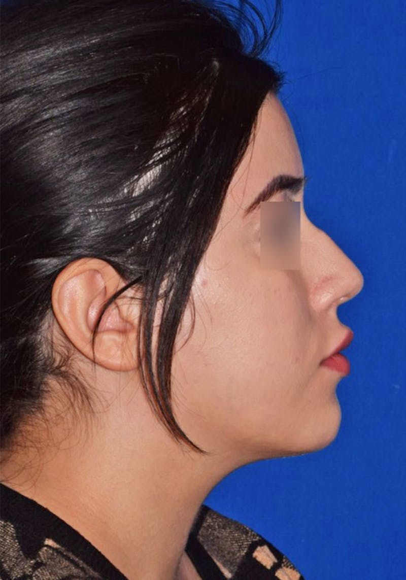 Face Before & After Gallery - Patient 63360909 - Image 5