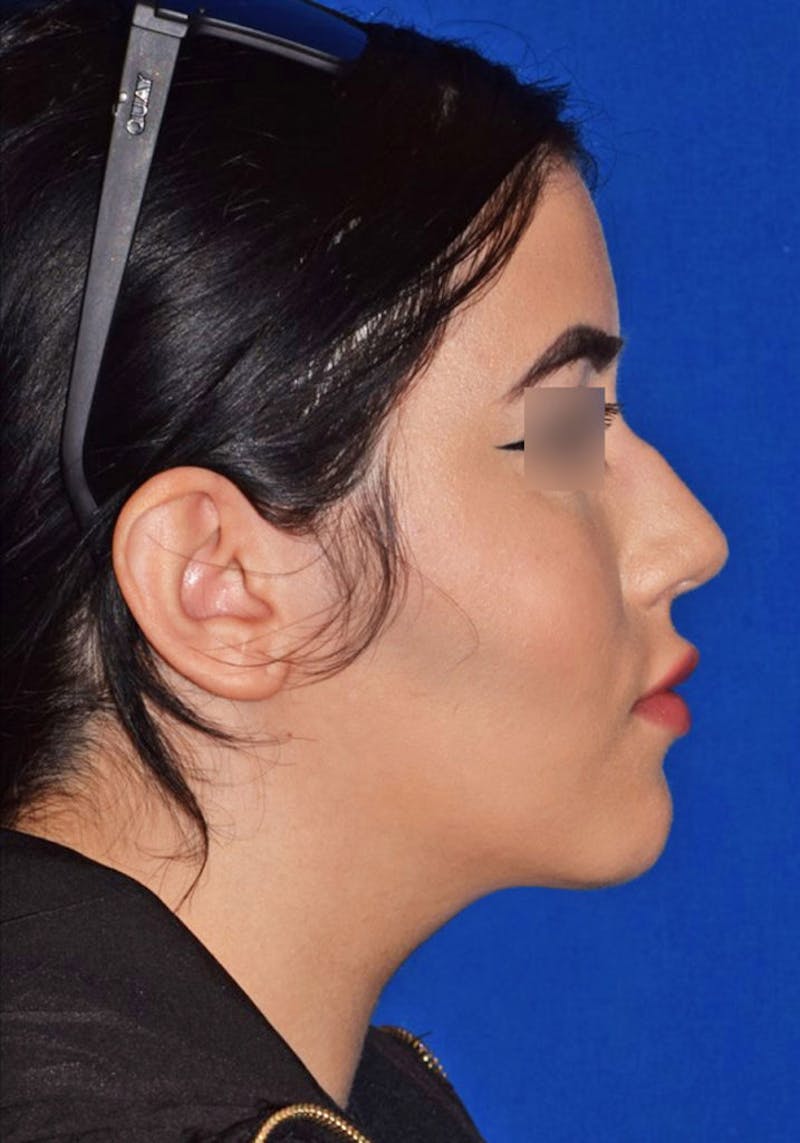 Face Before & After Gallery - Patient 63360909 - Image 6