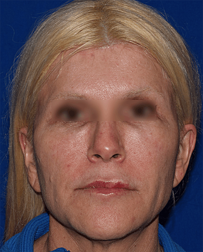 Face Before & After Gallery - Patient 63360910 - Image 1