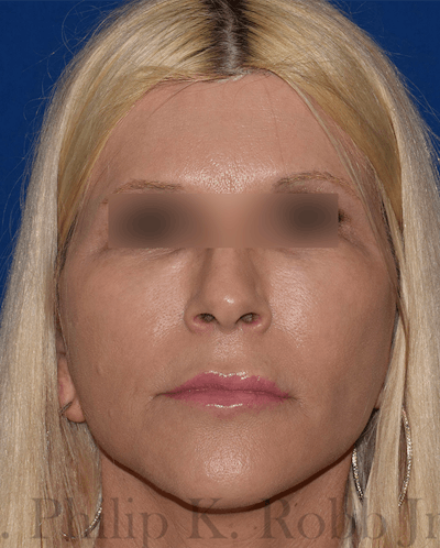 Face Before & After Gallery - Patient 63360910 - Image 2