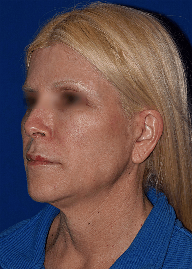 Cosmetic Surgical Before & After Gallery - Patient 63360910 - Image 3