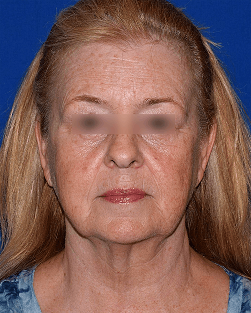 Face Before & After Gallery - Patient 63360913 - Image 1