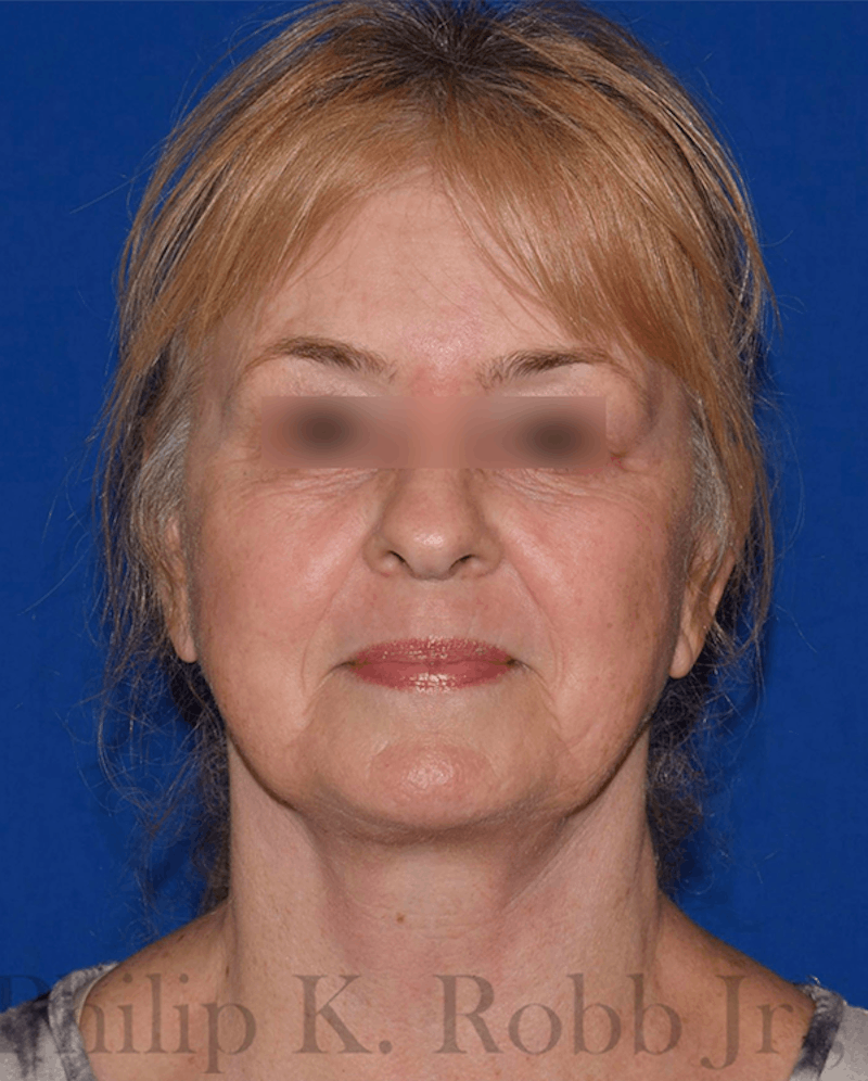 Face Before & After Gallery - Patient 63360913 - Image 2