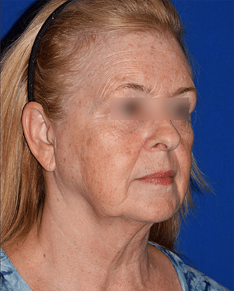 Cosmetic Surgical Before & After Gallery - Patient 63360913 - Image 3