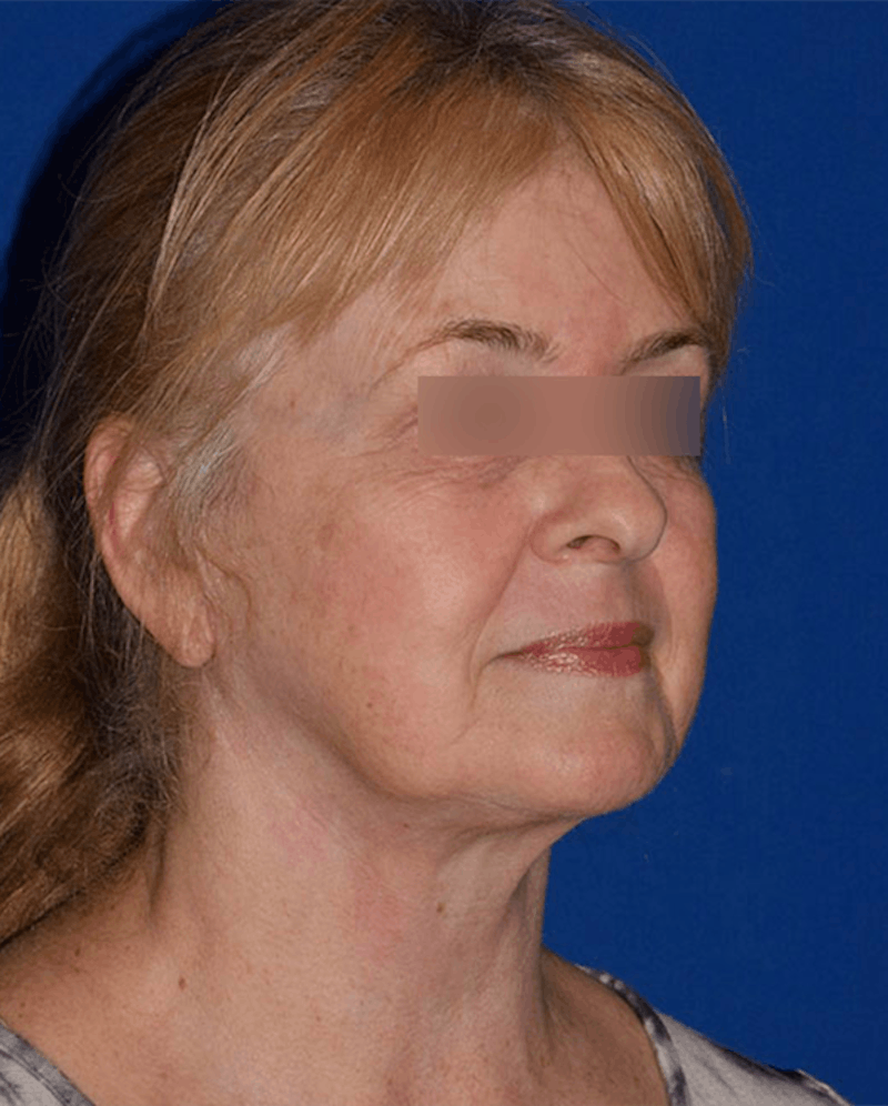 Face Before & After Gallery - Patient 63360913 - Image 4