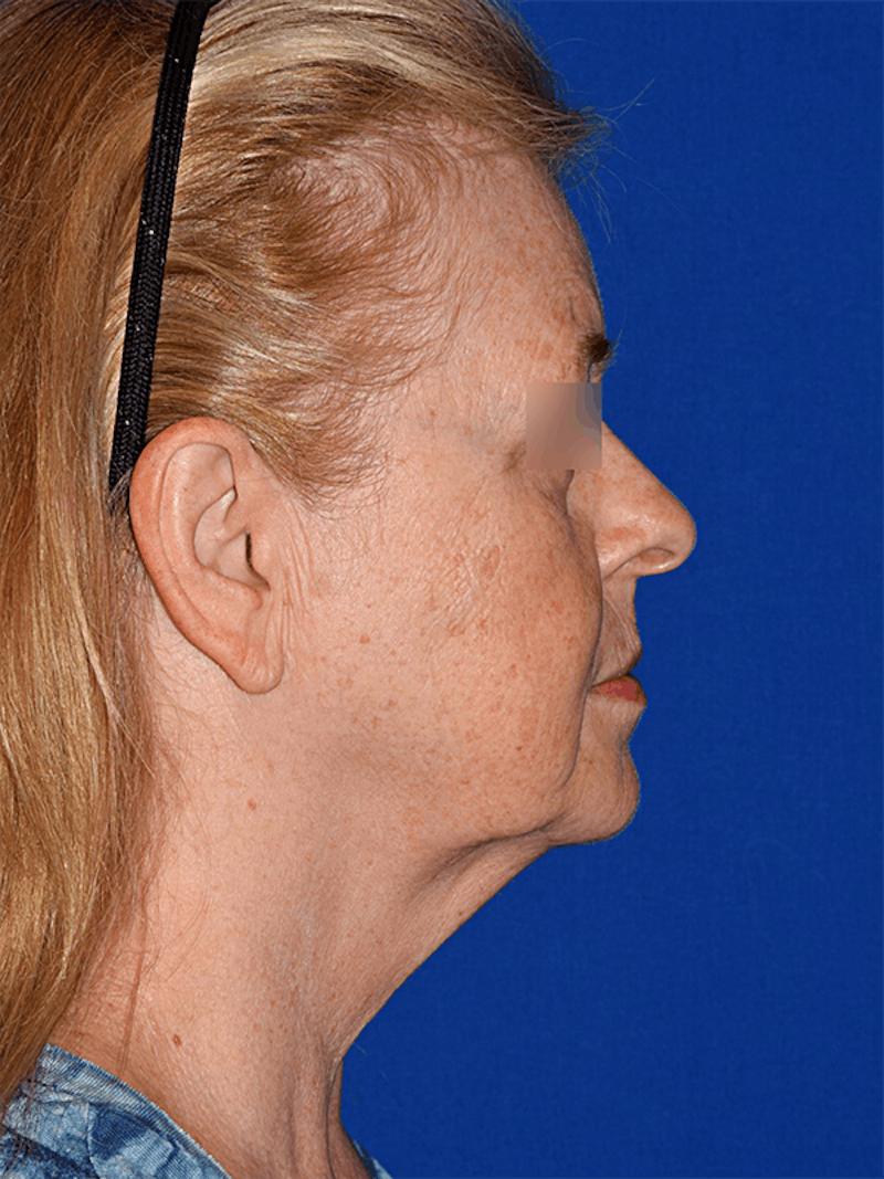 Cosmetic Surgical Before & After Gallery - Patient 63360913 - Image 5