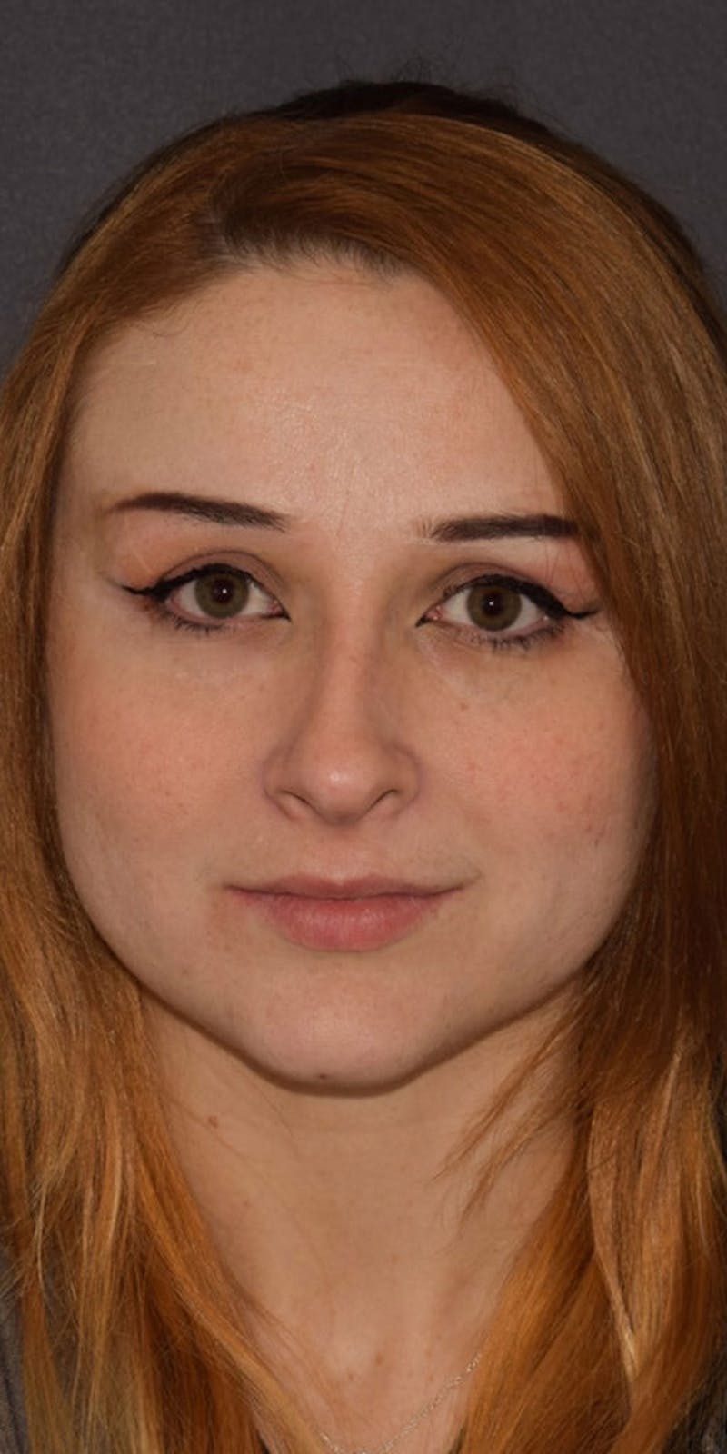 Cosmetic Surgical Before & After Gallery - Patient 63360918 - Image 1