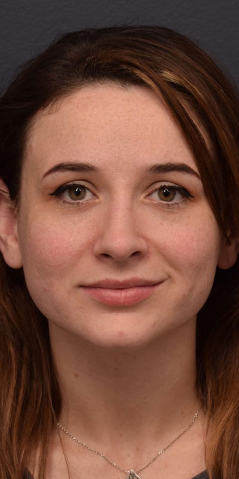 Cosmetic Surgical Before & After Gallery - Patient 63360918 - Image 2