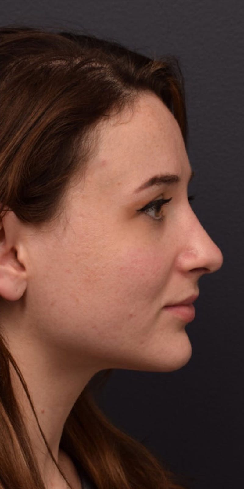 Cosmetic Surgical Before & After Gallery - Patient 63360918 - Image 6