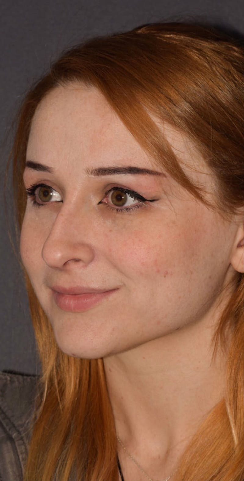 Cosmetic Surgical Before & After Gallery - Patient 63360918 - Image 7
