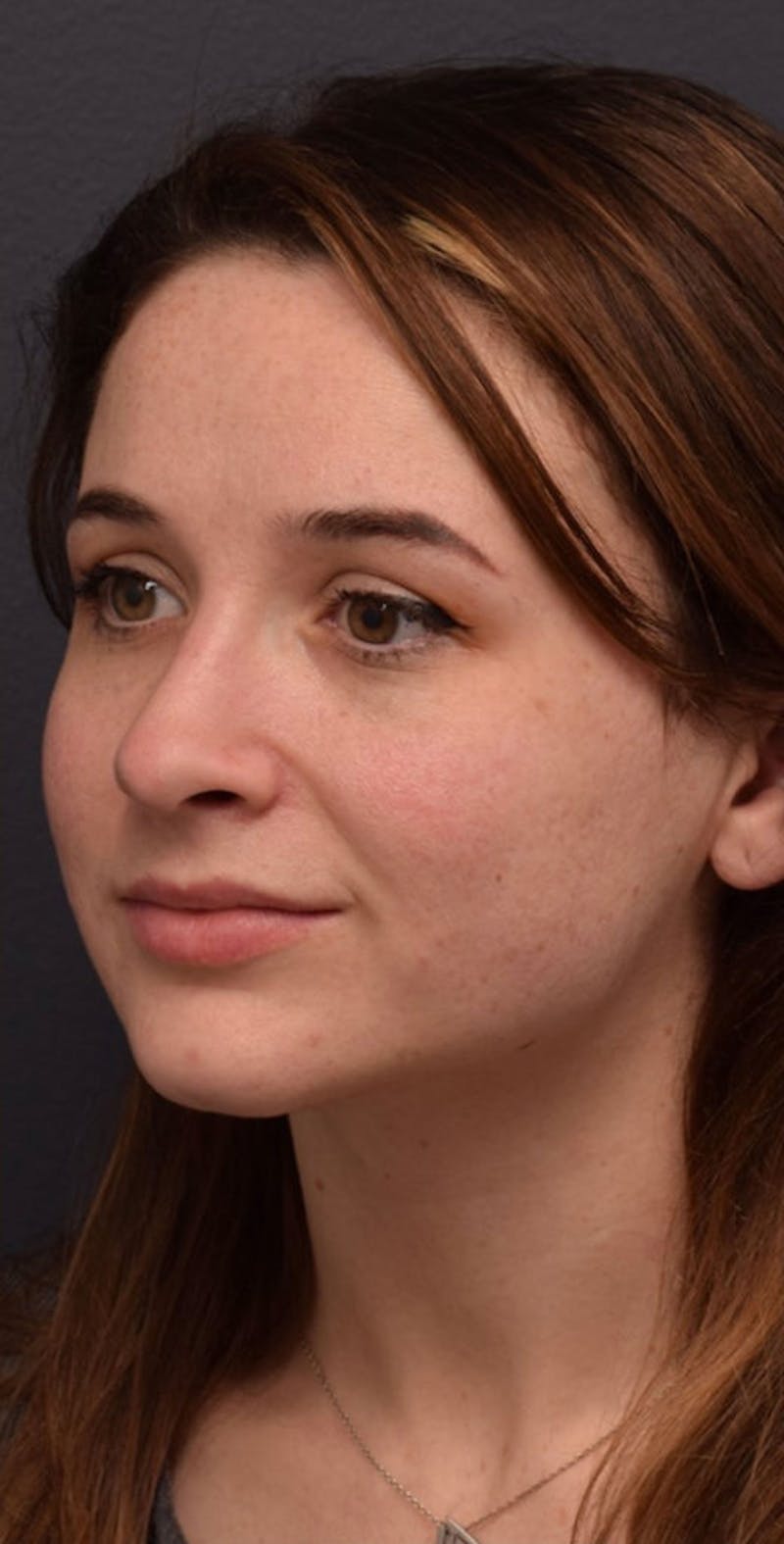 Cosmetic Surgical Before & After Gallery - Patient 63360918 - Image 8