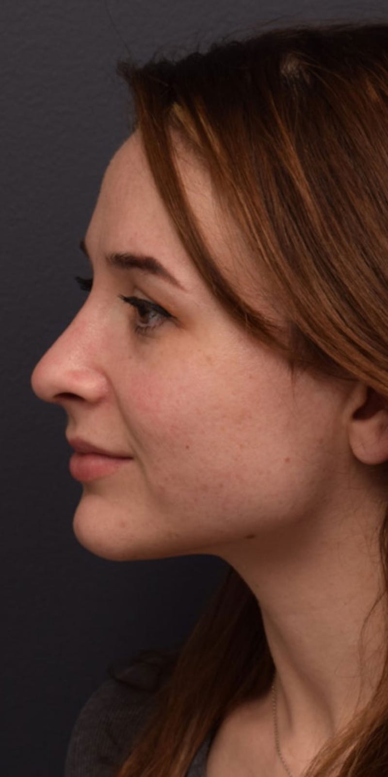 Cosmetic Surgical Before & After Gallery - Patient 63360918 - Image 10
