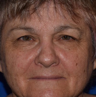 Face Before & After Gallery - Patient 63360921 - Image 1
