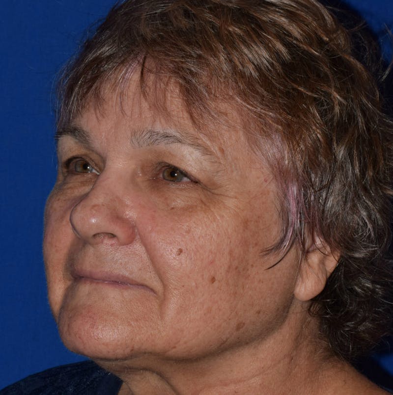 Face Before & After Gallery - Patient 63360921 - Image 3