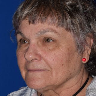 Face Before & After Gallery - Patient 63360921 - Image 4