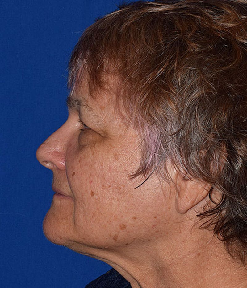 Face Before & After Gallery - Patient 63360921 - Image 5