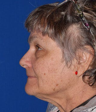 Face Before & After Gallery - Patient 63360921 - Image 6