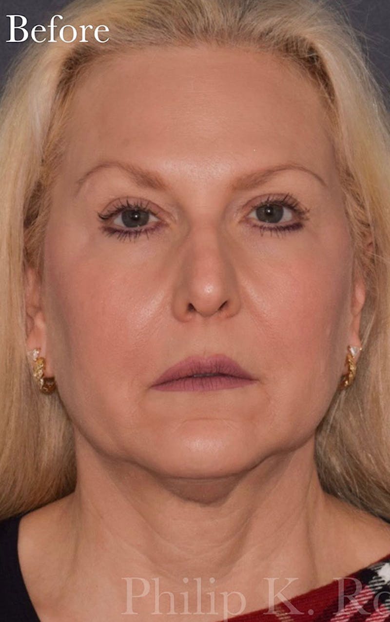 Face Before & After Gallery - Patient 63360924 - Image 1