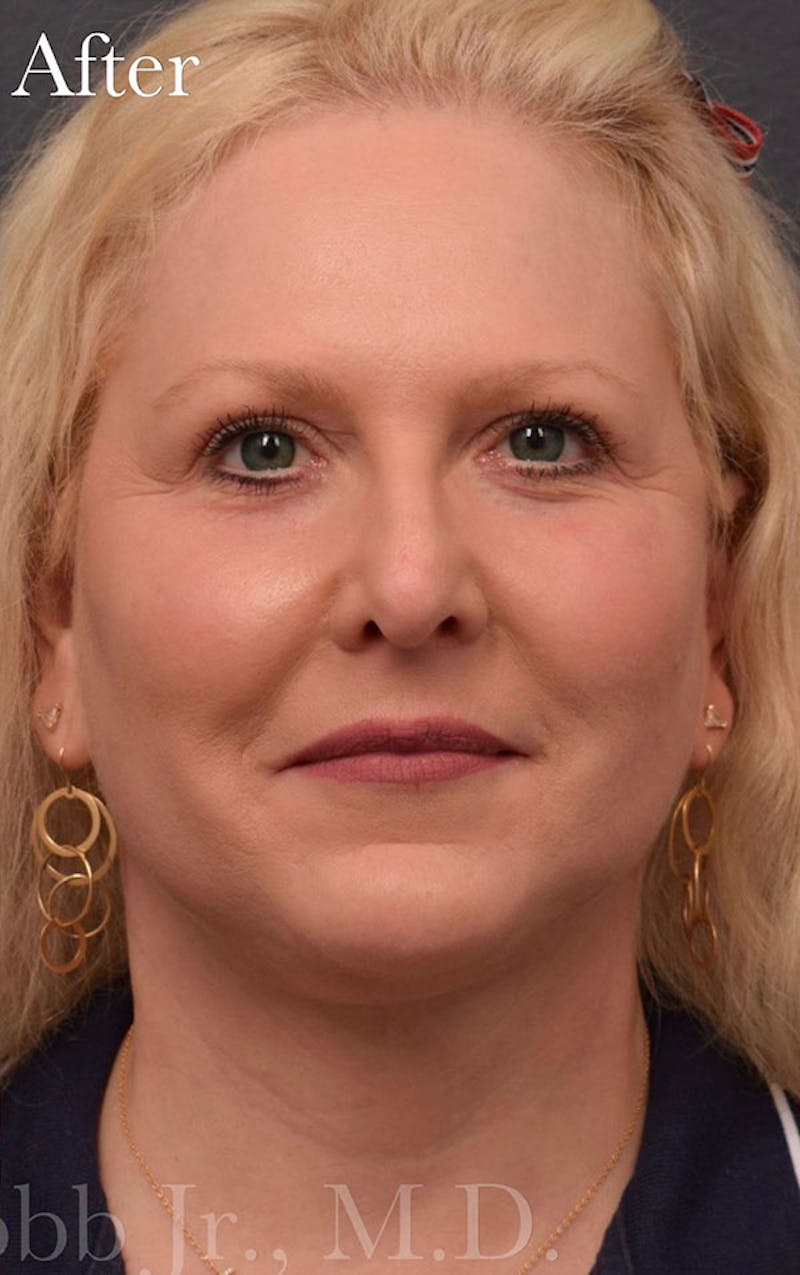 Face Before & After Gallery - Patient 63360924 - Image 2