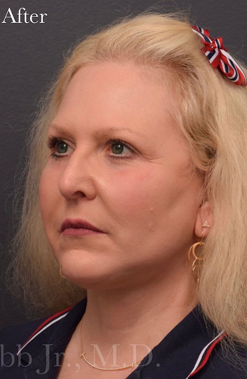Face Before & After Gallery - Patient 63360924 - Image 4