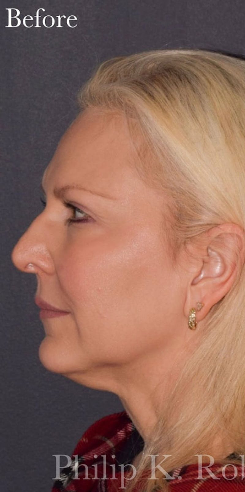 Face Before & After Gallery - Patient 63360924 - Image 5