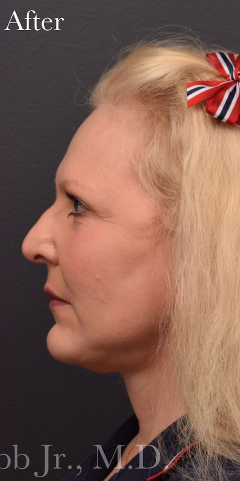 Face Before & After Gallery - Patient 63360924 - Image 6