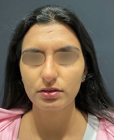 Cosmetic Surgical Before & After Gallery - Patient 63360926 - Image 1