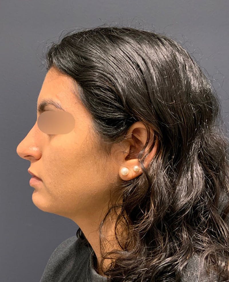 Cosmetic Surgical Before & After Gallery - Patient 63360926 - Image 6