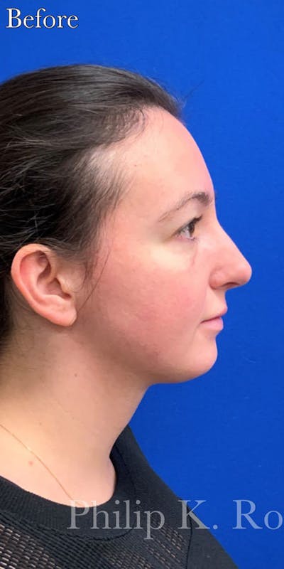 Cosmetic Surgical Before & After Gallery - Patient 63360930 - Image 1