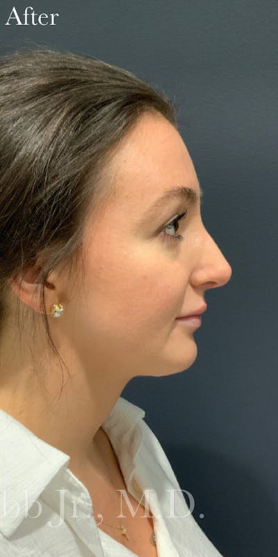 Face Before & After Gallery - Patient 63360930 - Image 2