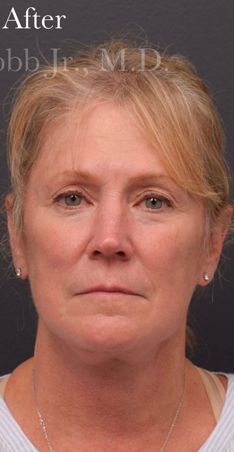 Cosmetic Surgical Before & After Gallery - Patient 63360935 - Image 2