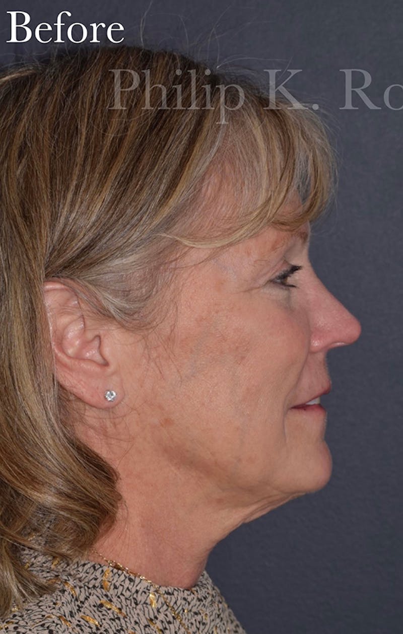 Cosmetic Surgical Before & After Gallery - Patient 63360935 - Image 5