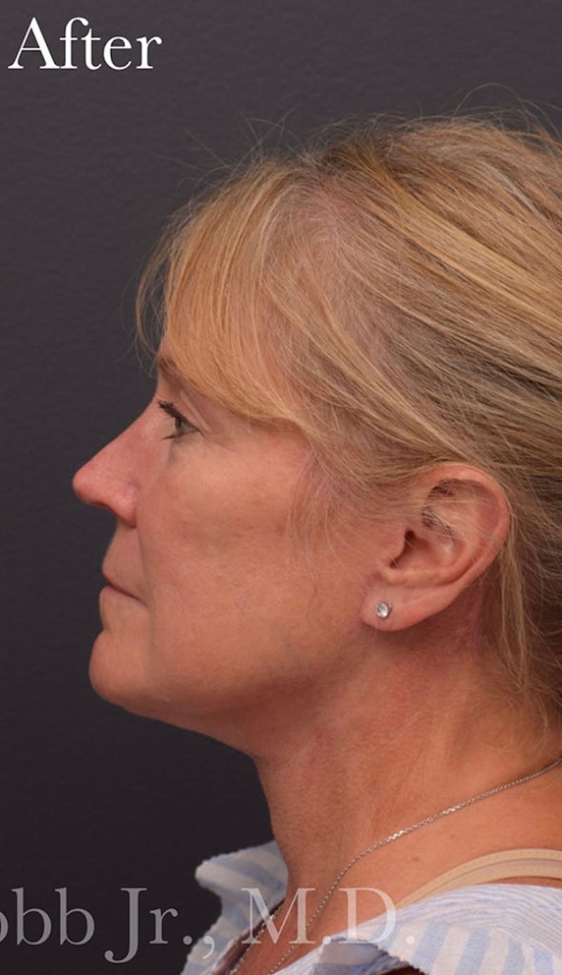 Face Before & After Gallery - Patient 63360935 - Image 10