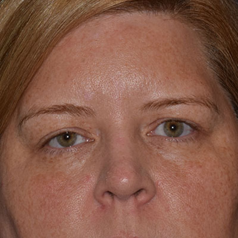 Cosmetic Surgical Before & After Gallery - Patient 63360939 - Image 1