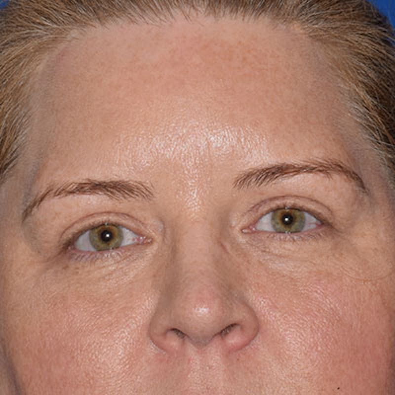 Cosmetic Surgical Before & After Gallery - Patient 63360939 - Image 2