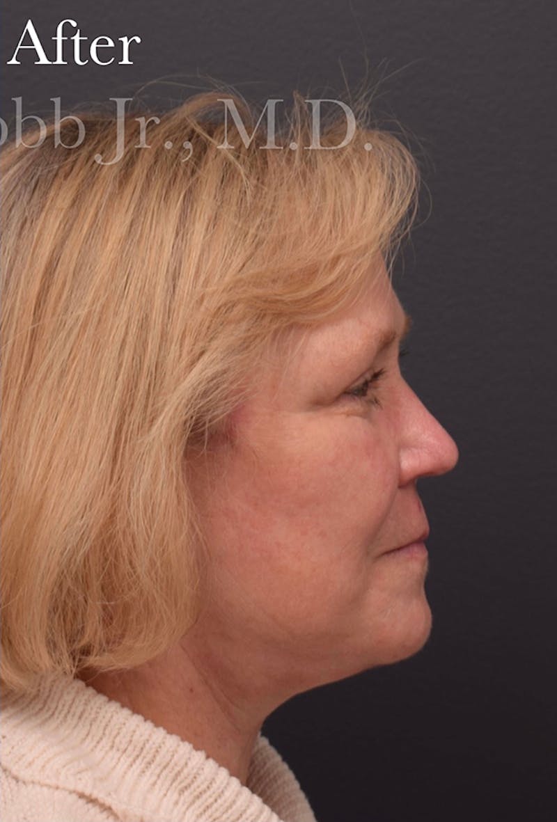 Cosmetic Surgical Before & After Gallery - Patient 63360940 - Image 6