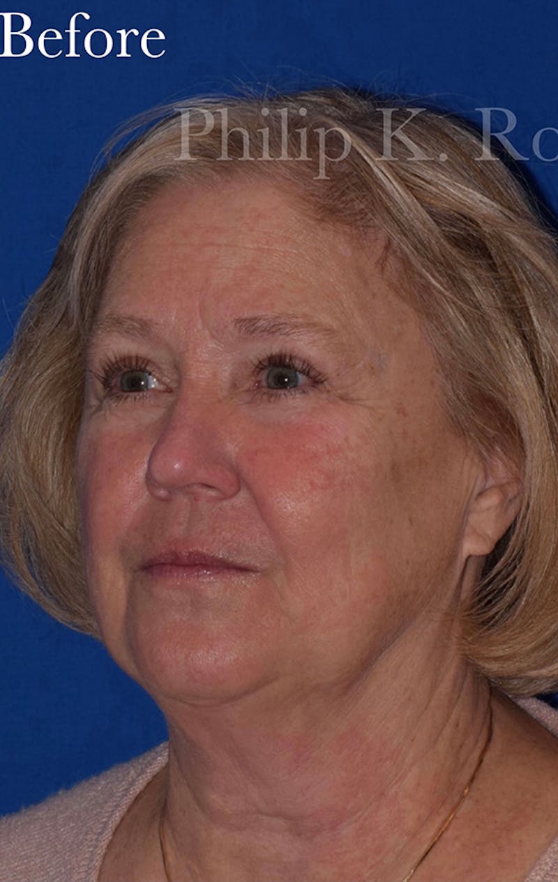 Face Before & After Gallery - Patient 63360940 - Image 7