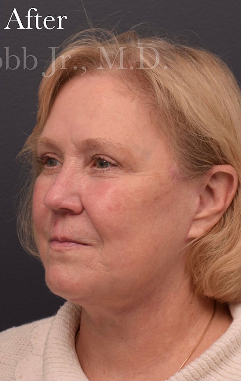 Face Before & After Gallery - Patient 63360940 - Image 8