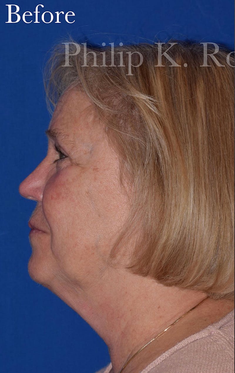 Cosmetic Surgical Before & After Gallery - Patient 63360940 - Image 9