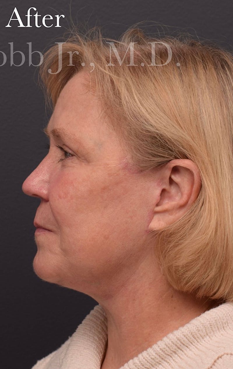 Face Before & After Gallery - Patient 63360940 - Image 10